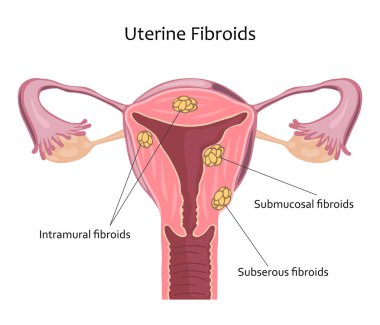 Uterin Fibroids illüstrasyon