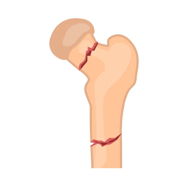 Icône de fracture de hanche — Image vectorielle