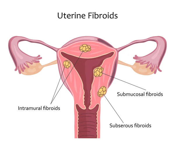 Illustrazione dei fibromi uterini — Vettoriale Stock