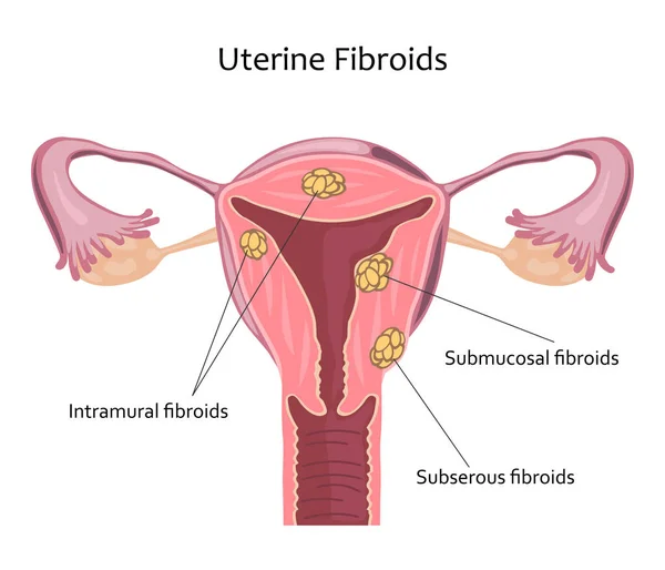 Ilustração de Fibroides Uterinos —  Vetores de Stock