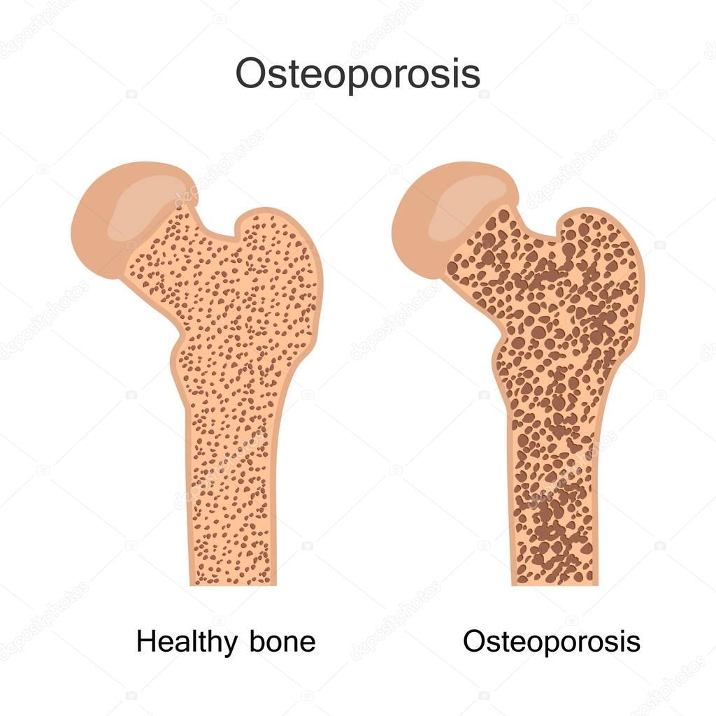 Bone Osteoporosis Illustration