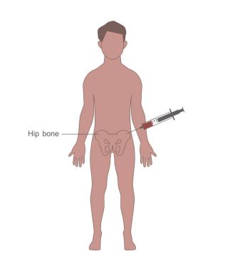 Donör kemik iliği hasat