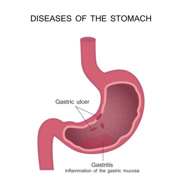 Diseases of the Stomach. Peptic Ulcer and Gastritis. clipart