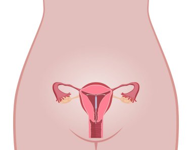 Intrauterine aygıt spiral