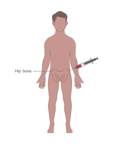 Raccolta del midollo osseo dal donatore — Vettoriale Stock