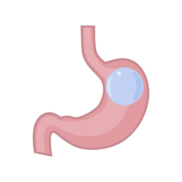 Gastric Balloon Stomach — Stock Vector