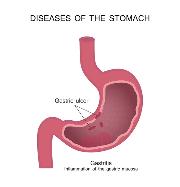 Enfermedades del Estómago. Úlcera péptica y gastritis . — Archivo Imágenes Vectoriales