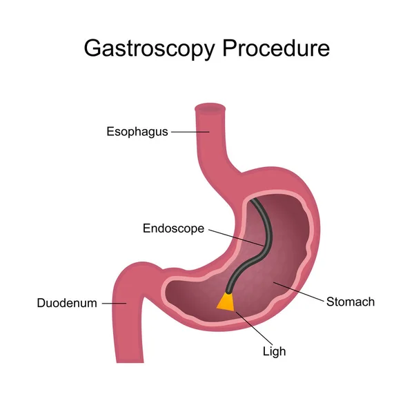 Gastroscopy Procedure Diagram — Stock Vector