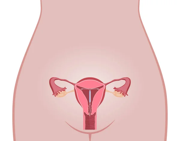 Dispositivo intrauterino DIU —  Vetores de Stock