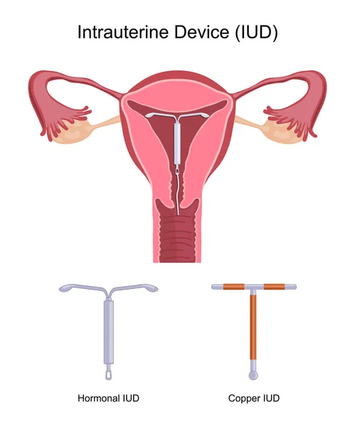 Dispositivo intrauterino DIU — Vector de stock