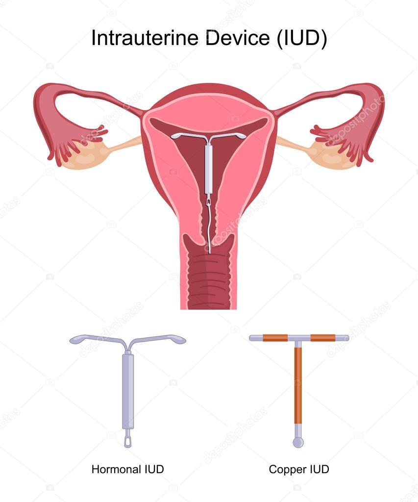 Intrauterine Device IUD