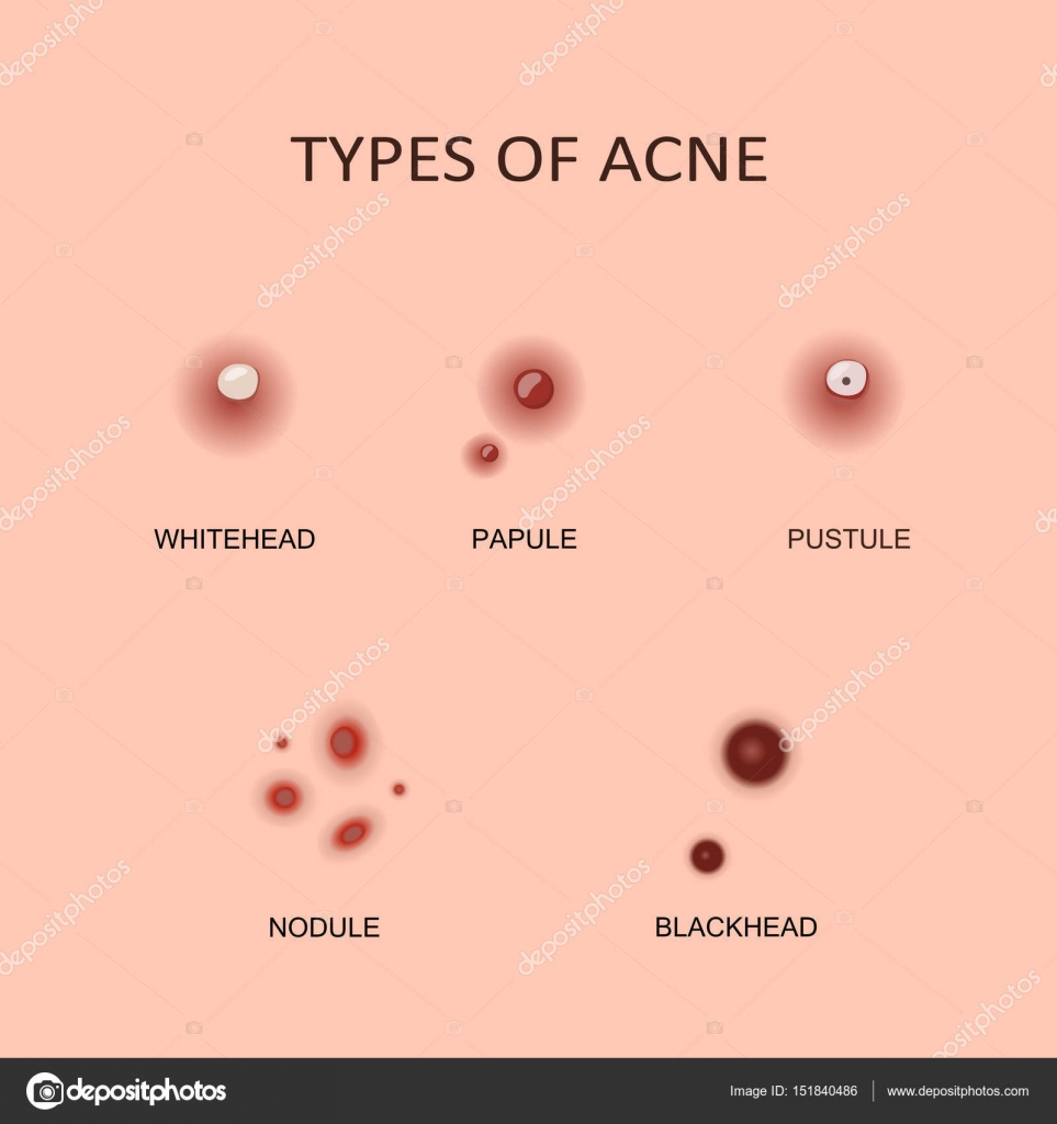Виды прыщей и прыщей Векторное изображение ©fancy.tapis.gmail.com 151840486