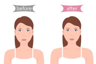 Akne ile kız önce ve sonra