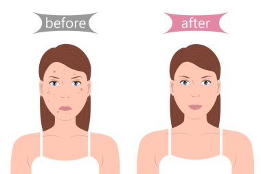 Girl with Acne Before and After clipart