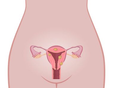 Uterine Fibroids Anatomy clipart