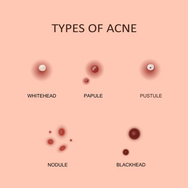 Akne ve sivilce türleri