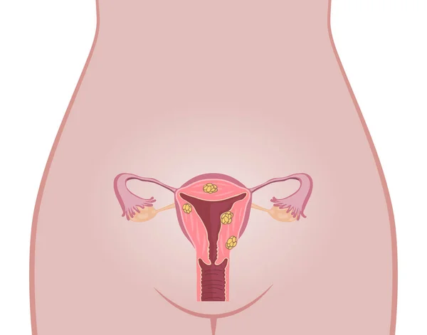 Anatomía de los fibromas uterinos — Vector de stock