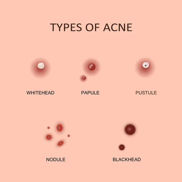 Soorten Acne en puistjes — Stockvector