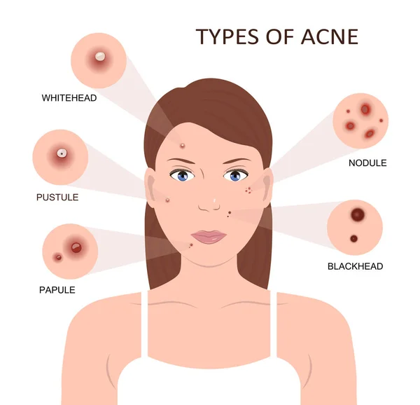 Types van acne. Vrouw met puistjes — Stockvector