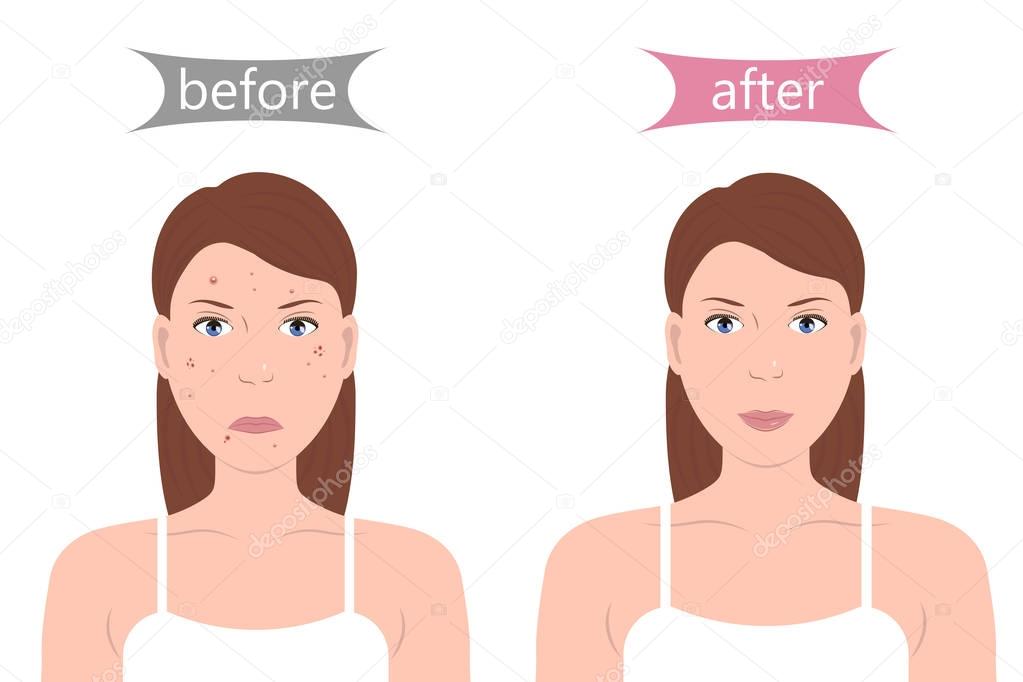 Girl with Acne Before and After