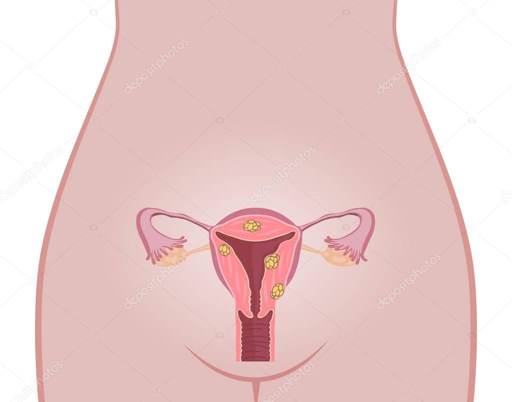 Uterine Fibroids Anatomy