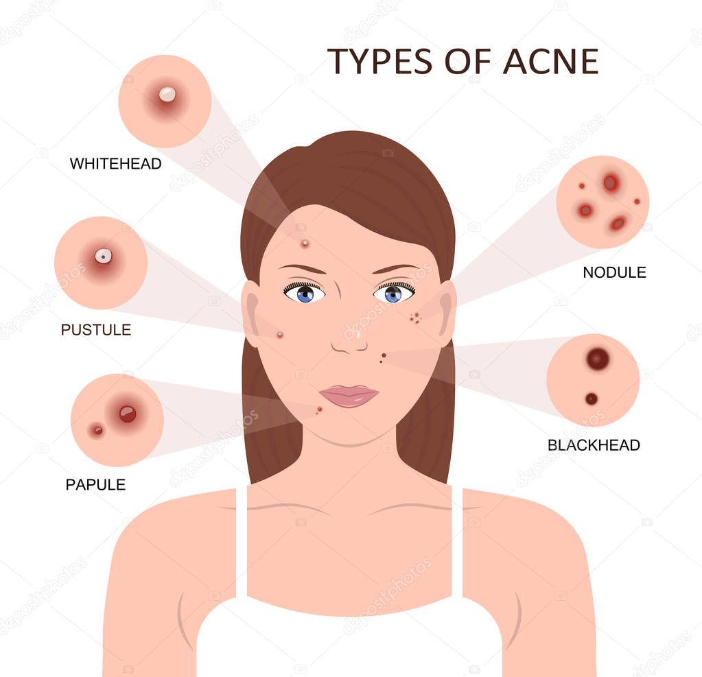 Types of acne. Woman with Pimples