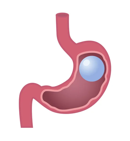 Stomaco gastrico del palloncino — Vettoriale Stock