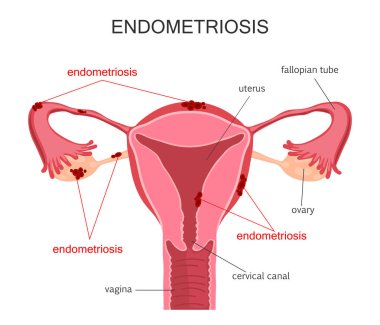 Rahim endometriozis diyagramı