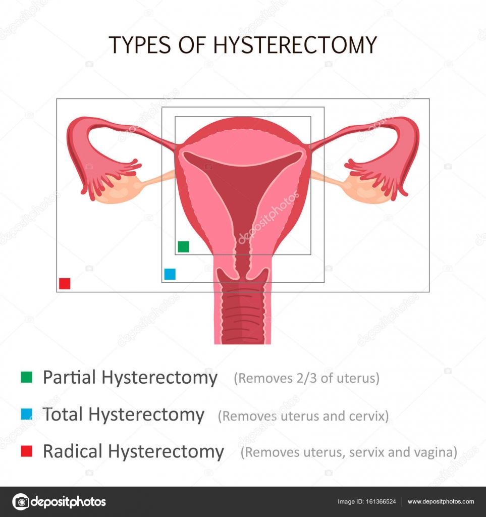Types of Hysterectomy Stock Vector Image by ©.com #161366524 Types of Hysterectomy Stock Vector Image by ©.com #161366524