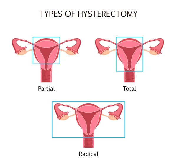 Tipos de histerectomia —  Vetores de Stock