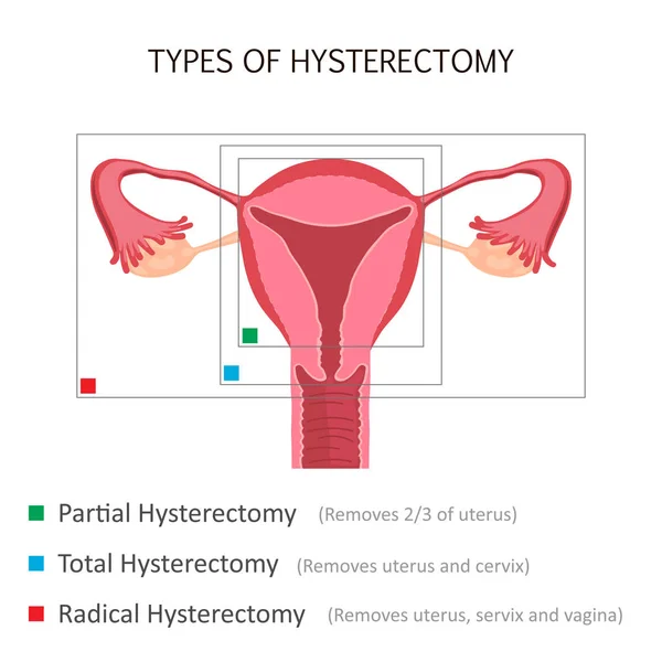 Soorten hysterectomie — Stockvector