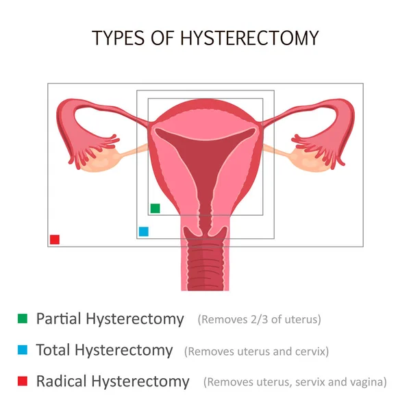 Tipos de histerectomia —  Vetores de Stock