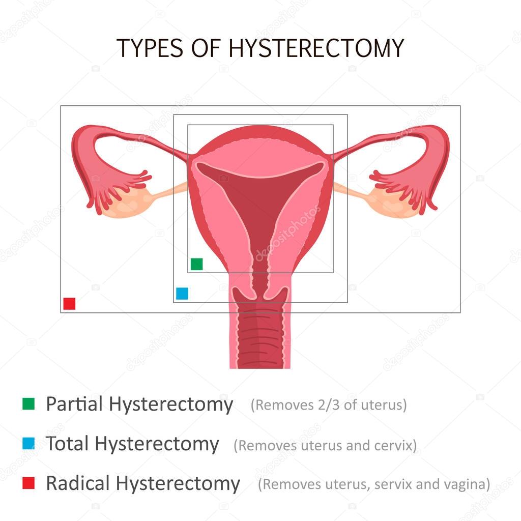 Types of Hysterectomy
