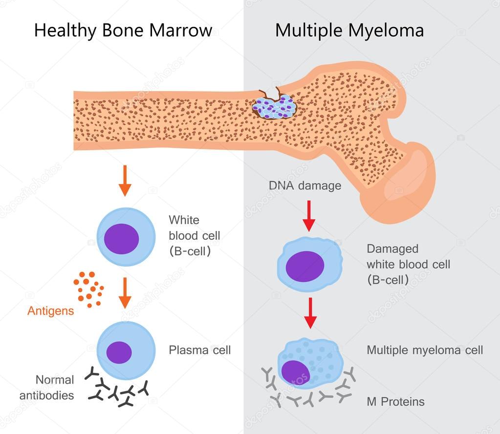 Multiple Myeloma Diagram