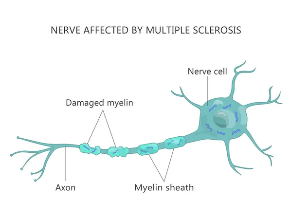 Multipel skleros Misslyckande Myelin celler Autoimmun sjukdom Vektorgrafik