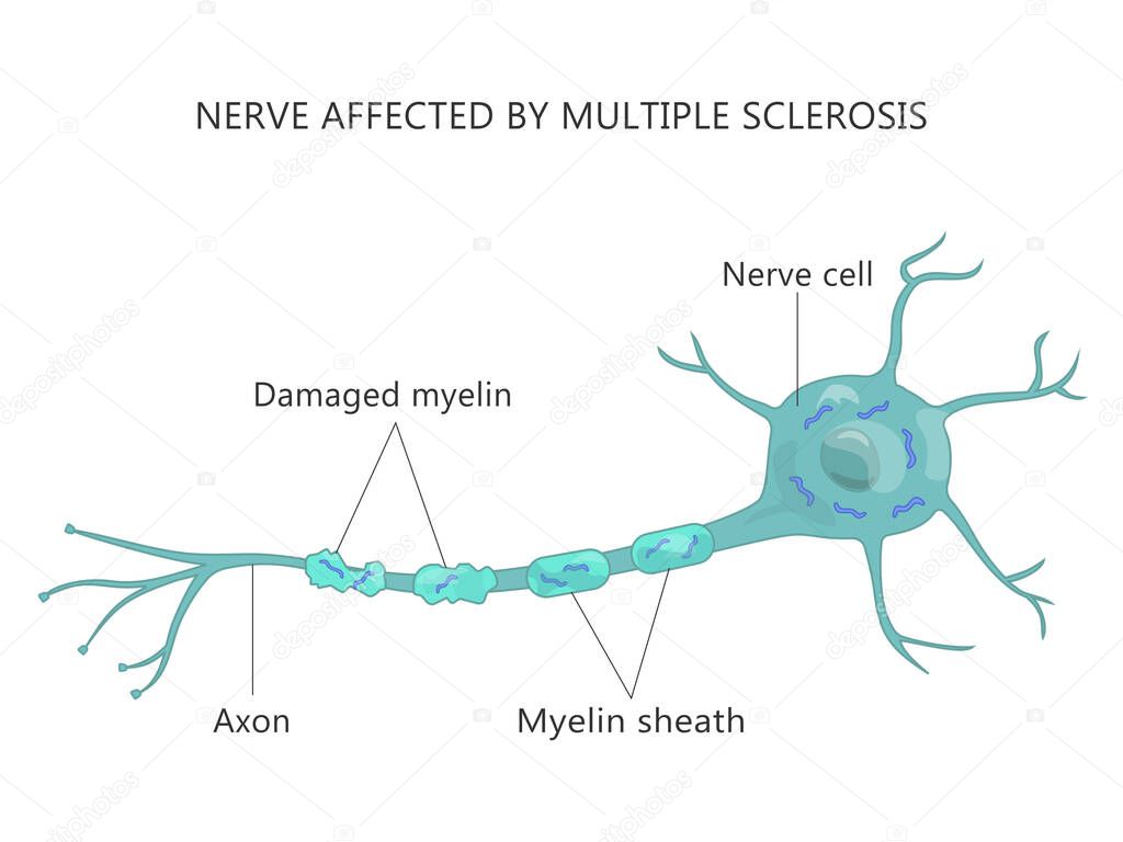 Multiple Sclerosis Failure Myelin Cells Autoimmune Disease