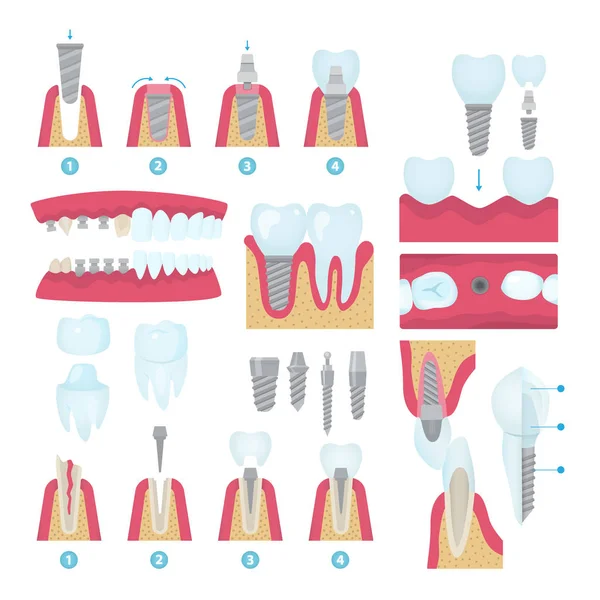 Dental crowns and implantation set — Stock Vector