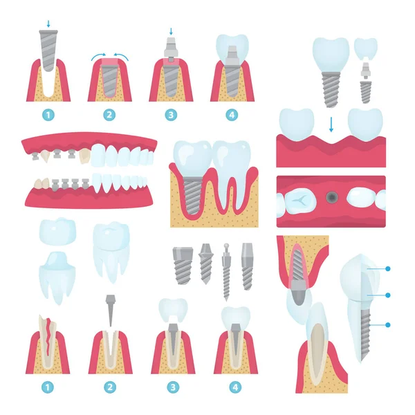 Стоматологічні коронки та набір імплантації — стоковий вектор