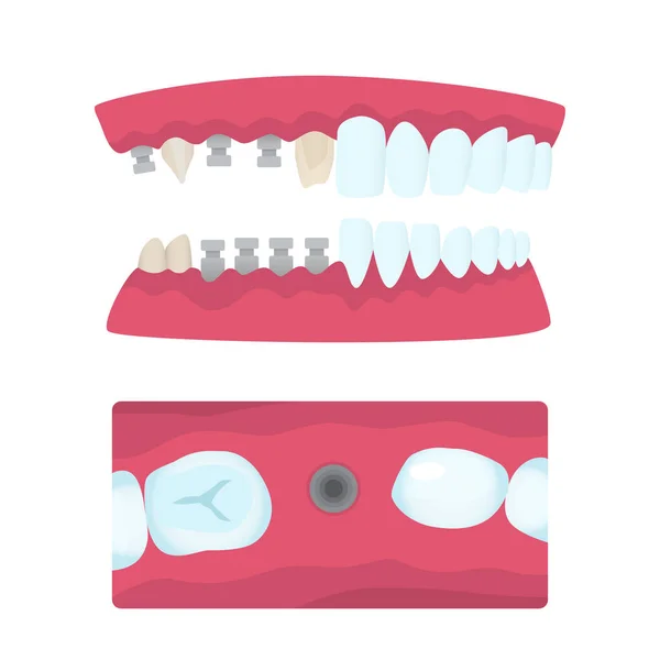 Coroas dentárias e implantação —  Vetores de Stock