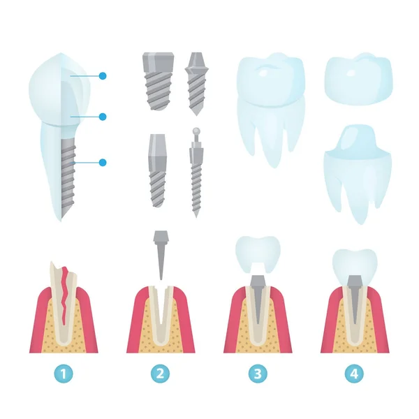 Coronas dentales e implantación — Archivo Imágenes Vectoriales