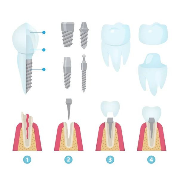 Dental korony i implantacji — Wektor stockowy