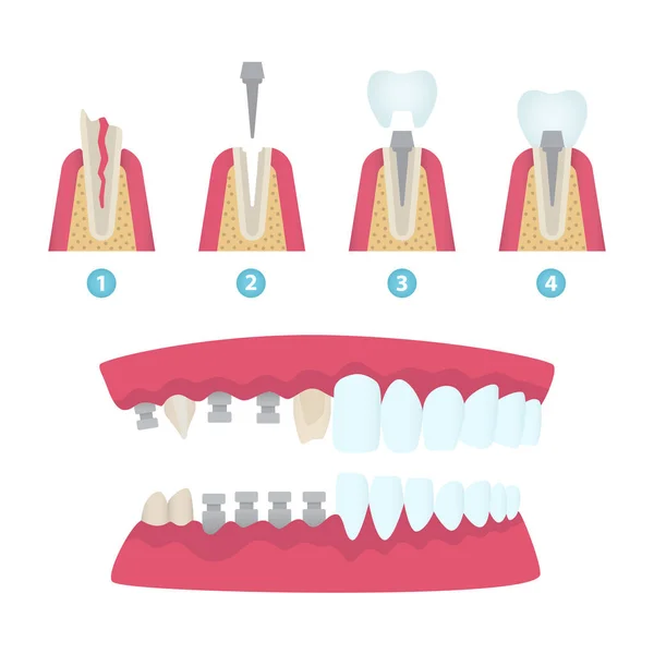 Dental crowns and implantation — Stock Vector