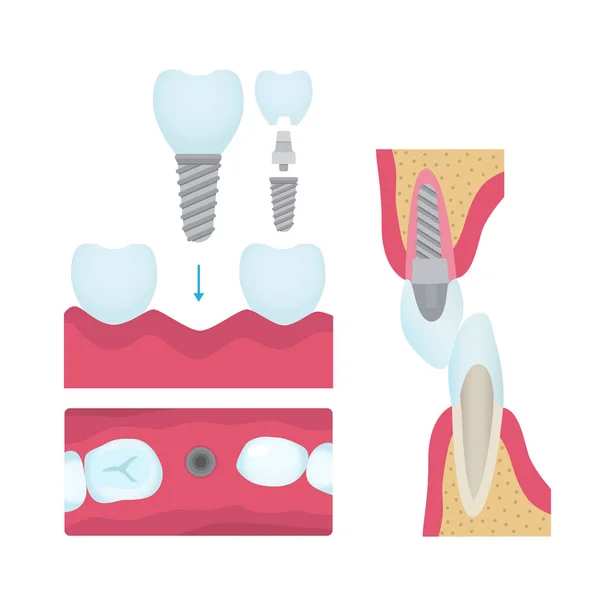 牙牙冠和植入术 — 图库矢量图片