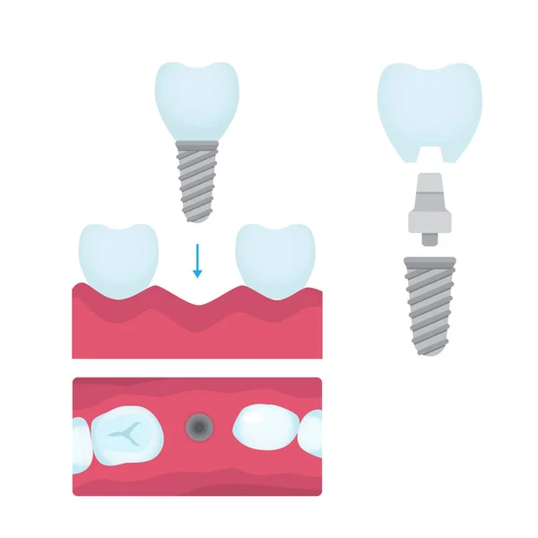 Couronnes dentaires et implantation — Image vectorielle