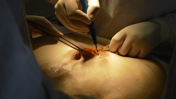 Chirurg Schneidet Mit Elektrischer Klinge — Stockvideo