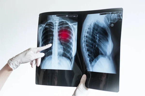 Doctors hands holding x-ray photo of lungs showing disease. Covid-2019 Coronavirus infection — Stock Photo, Image