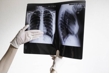 Doktorlar akciğerlerinde hastalık olduğunu gösteren röntgen fotoğrafını tutuyorlar. Covid-2019 Coronavirüs enfeksiyonu 