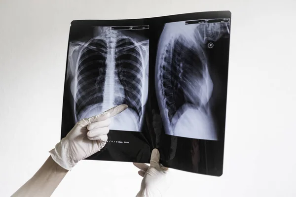 Doktorlar akciğerlerinde hastalık olduğunu gösteren röntgen fotoğrafını tutuyorlar. Covid-2019 Coronavirüs enfeksiyonu 