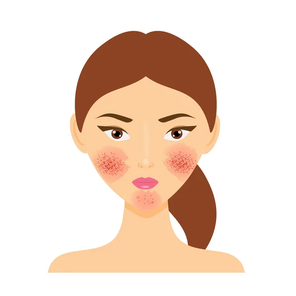 Donna con problemi alla pelle della rosacea. Illustrazione vettoriale — Vettoriale Stock