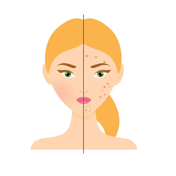 Donna con problemi di pelle acne e pelle sana. Illustrazione vettoriale — Vettoriale Stock